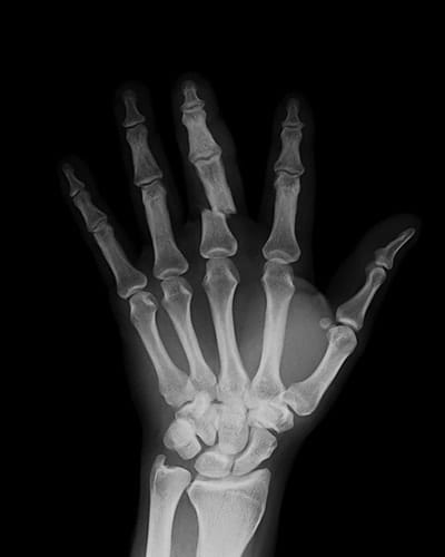 Hand fractures